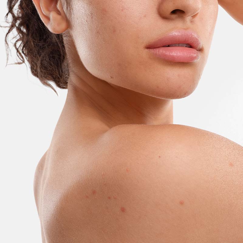 acne