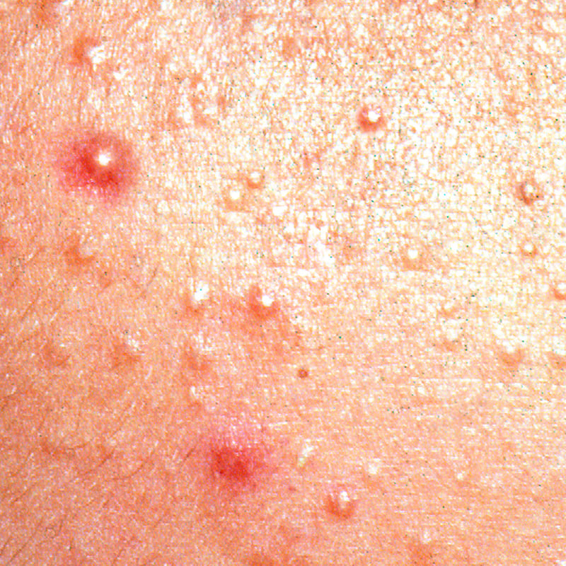Acne rosacea with visible bumps and redness on sen