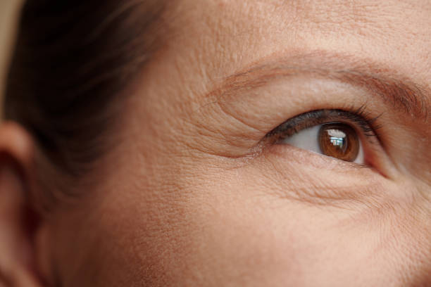crows feet